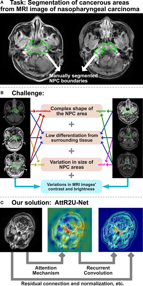 Frontiers AttR2U Net A Fully Automated Model For MRI Nasopharyngeal