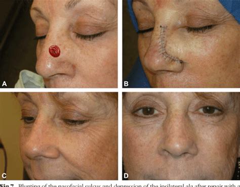 The Superiorly Based Bilobed Flap For Nasal Reconstruction Semantic