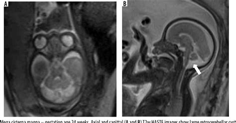 Figure 1 From Imaging Spectrum Of Posterior Fossa Anomalies On Foetal