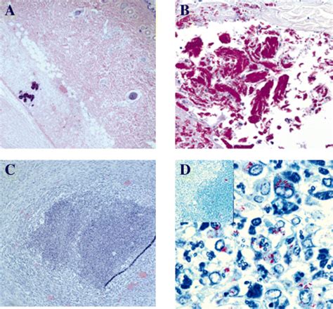 Mycobacterium Ulcerans Toxic Macrolide Mycolactone Modulates The Host