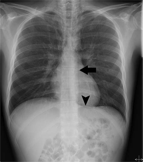 Spontaneous Pneumomediastinum Bmj Case Reports