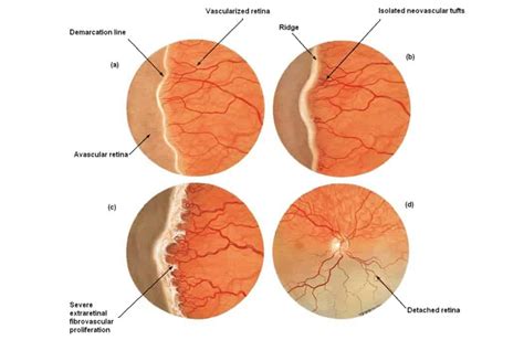 Retinopathy Of Prematurity Zones