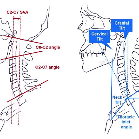 Schematic Drawings Of The Conventional Cervical Alignment Parameters Download Scientific