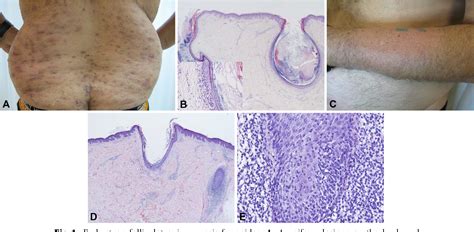 Figure 1 From New Insights Into Folliculotropic Mycosis Fungoides Fmf