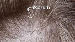 What are Nits & What do they look like? | LCA Nova Lice Removal Clinic