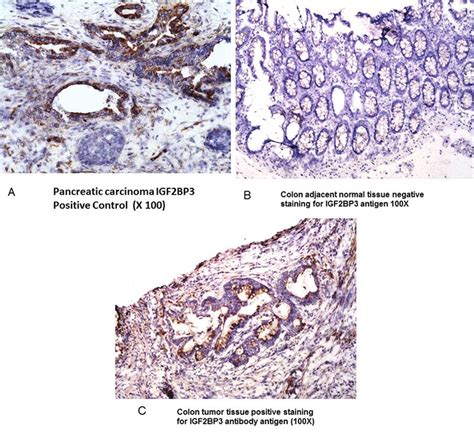 A Immunohistochemistry Ihc Staining Of Pancreatic Carcinoma Positive