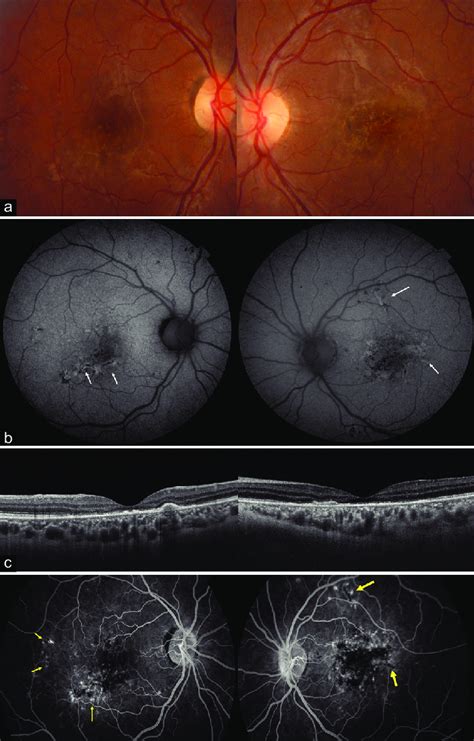 Examinations At Presentation A Color Fundus Photographs Of The Right