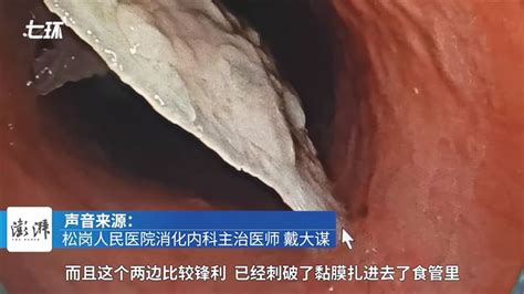 喝完粥頸部超痛！ct一照「超尖排骨卡食道」她嚇壞：被戳破了 兩岸 大陸 三立新聞網 Setn