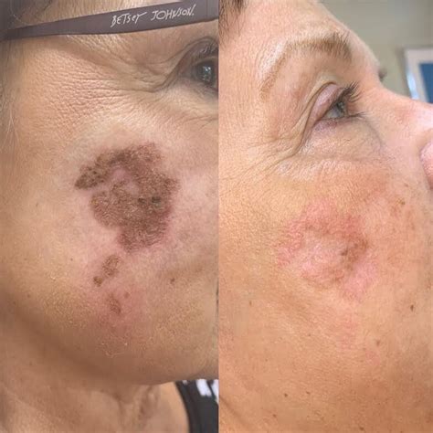 Fibroblast Plasma Pen Before Afters Skin Studio Okc