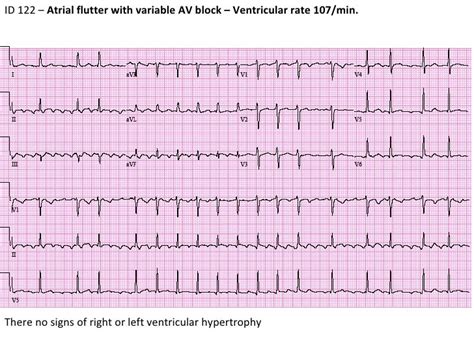 Ecg 10 Id122 Atrial Flutter