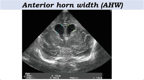 Radiology Case 10 Neonatal Germinal Matrix Hemorrhage Cranial