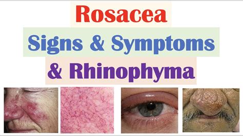 Rosacea Signs Symptoms Including Ocular Rosacea Rhinophyma Youtube