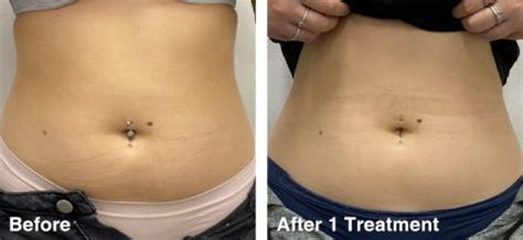 Cryolipolysis-Before-&-After-07 – The Global Beauty Group