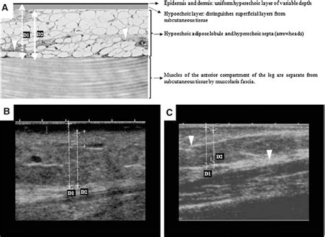 Ultrasound Assessment Of The Pretibial Skin Area In Pretibial Myxedema