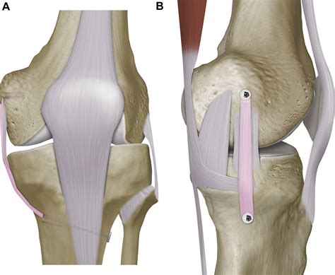 Surgical Techniques For The Reconstruction Of Medial Collateral