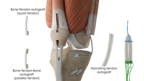 Posterior Cruciate Ligament Reconstruction Doctor Matthieu Meyer