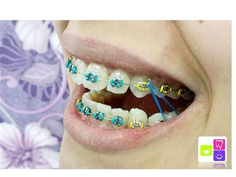 How to pick the best teal braces for your teeth? | Braces Explained