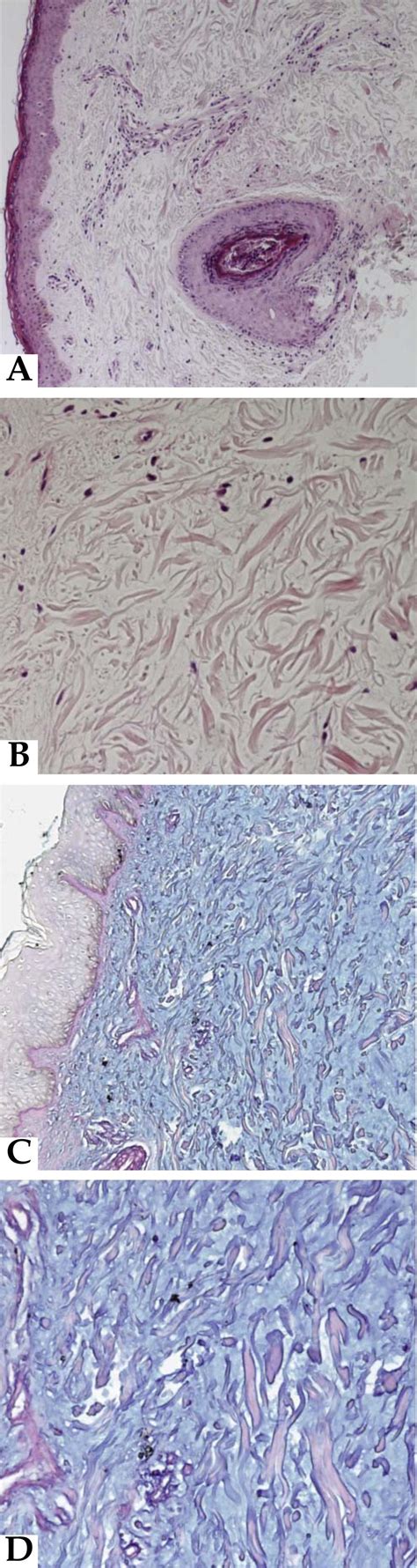 Scielo Brasil Cutaneous Mucinosis In Mixed Connective Tissue