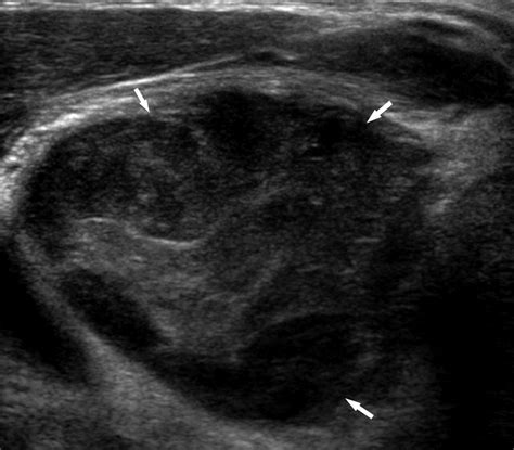 Us Guided Fine Needle Aspiration Of Thyroid Nodules Indications Techniques Results