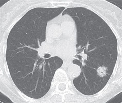 Neoplasms Of The Lung Radiology Key