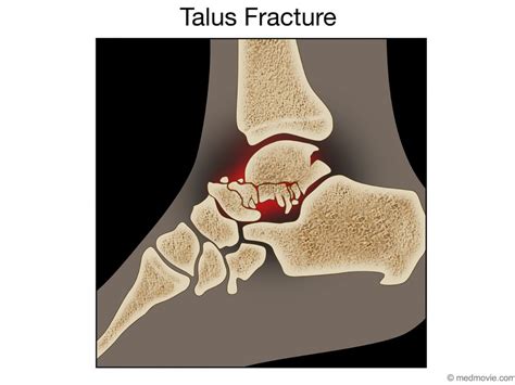 Talus Fracture In The Foot Medmovie