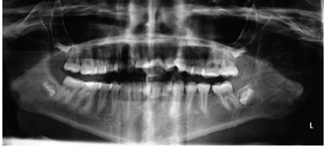 Presurgical Orthopantomograph Showing Radiolucent Multilobulated