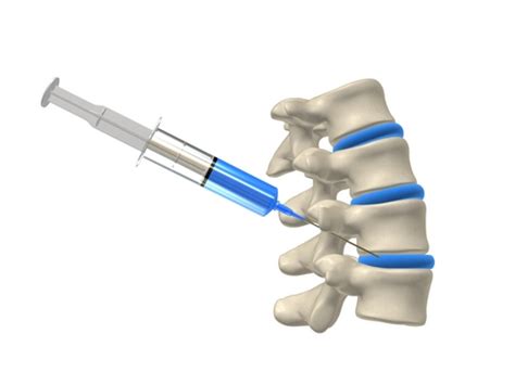 Corticosteroid Injections