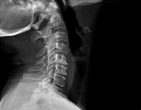 Cervical Disc Herniation Los Angeles | Herniated Disc Surgery | Dr. Kropf