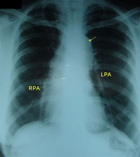 Intimal calcification in aortic knuckle – X-ray chest PA – All About ...