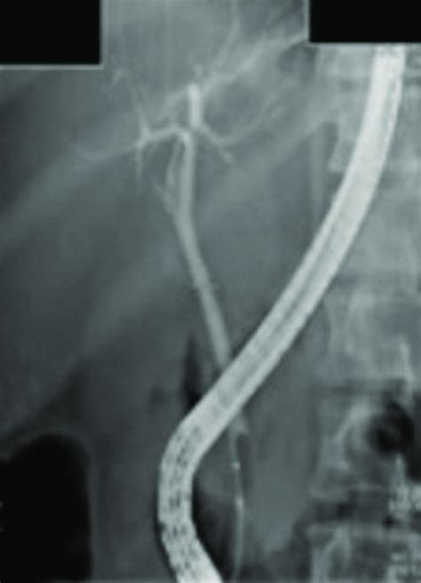 Fluoroscopic Image Revealing A Normal Balloon Occlusion Cholangiogram