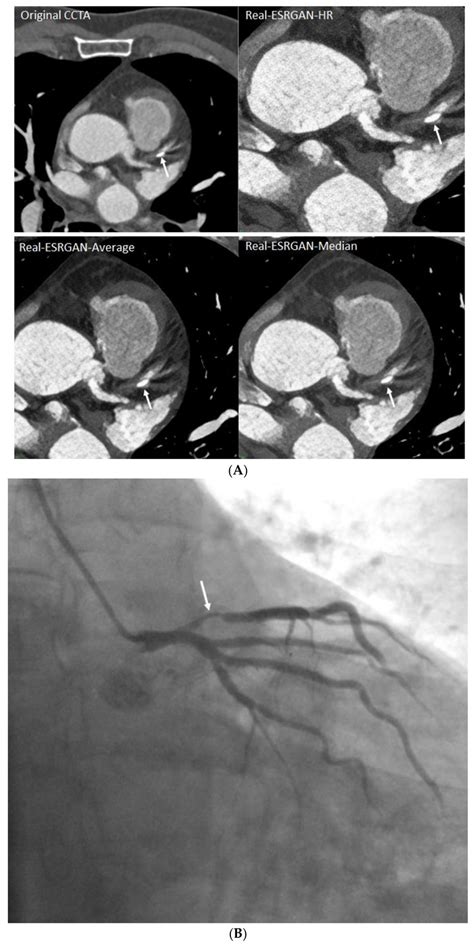 A calcified plaque at the proximal segment of left anterior descending ...