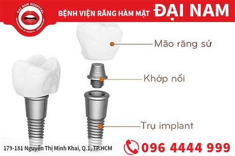 Chia sẻ thông tin Cấy ghép implant có đau không Trung tâm Nha khoa