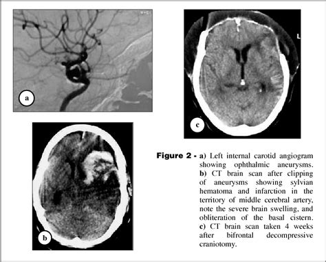 Figure 1 From Bifrontal Decompressive Craniotomy For Malignant Brain Edema Semantic Scholar