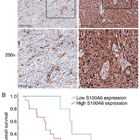 S A Expression In A Clinical Cohort Of Glioma Patients And An