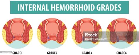 Anatomy Of Human Internal Hemorrhoid In Different Grades Stock