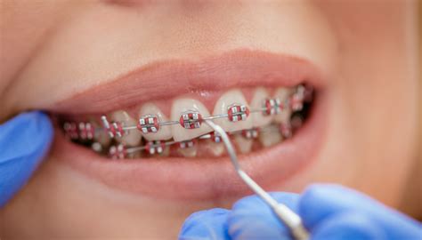 Qué tipos de ligas existen para los brackets Variedades y Uso