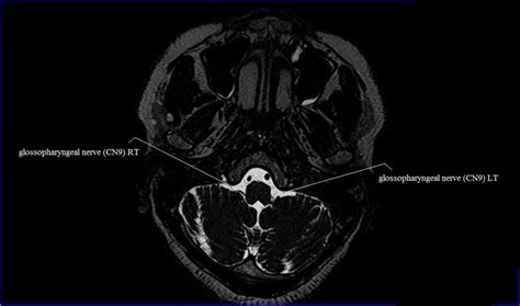 Glossopharyngeal Nerve Mri