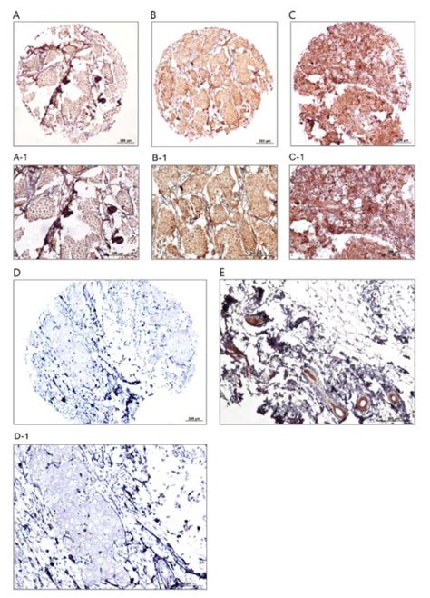 Overexpression And Translocation Of Dynamin Promotes Tumor