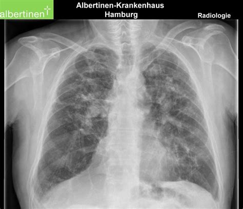 X-ray of the thorax: Sarcoidosis III p.a. - DocCheck