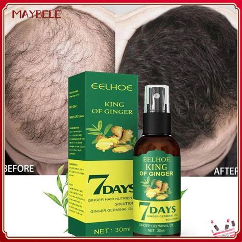 7 Eelhoe Days King Of Ginger Hair Growth Spray Hair Loss Prevention