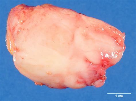 Ganglioneuromatosis