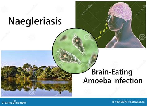 Cerveau Consommation De L Infection D Amibe Naegleriasis Illustration