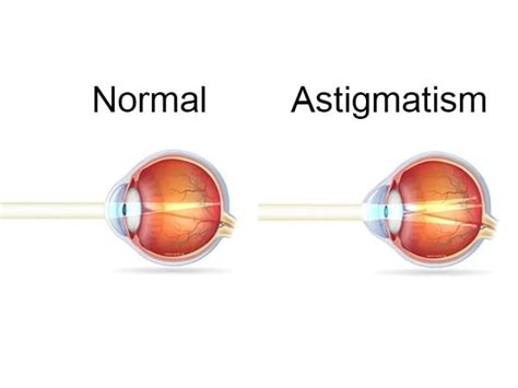 What Is Astigmatism Astigmatism Vs Normal Vision