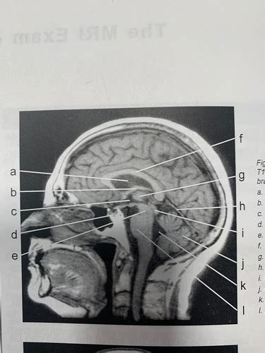 Mri Anatomy Flashcards Quizlet