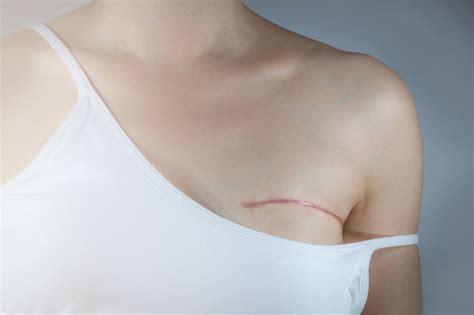 How to Cover Mastectomy Scars with The Best Makeup