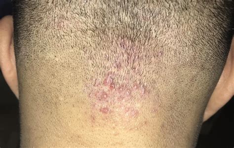 Diagnosis And Treatment For Scalp Infections