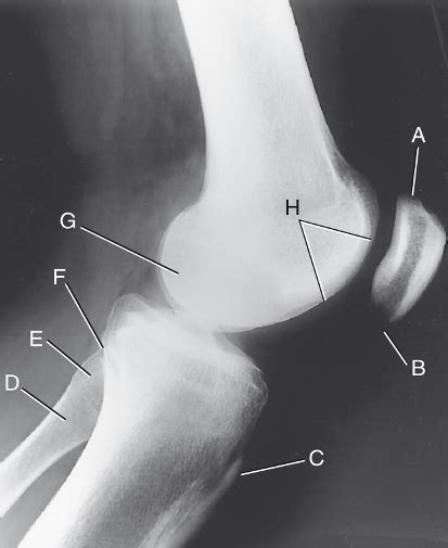 Lateral Knee X-ray Anatomy Diagram | Quizlet