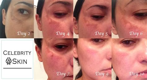 Chemical Peels Aging Acne Wrinkles Brown Spots Melasma