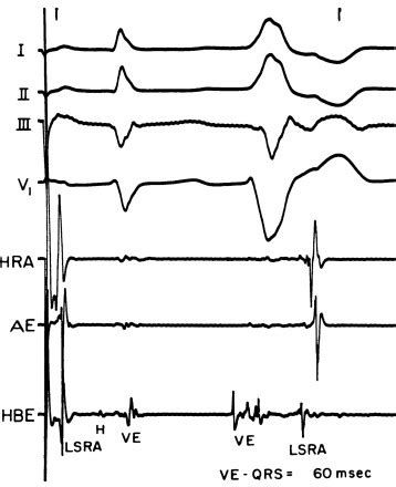 Endocardial Mapping Of A Para Hisian PVC CHEST