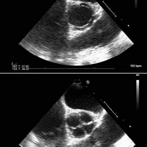 Transesophageal Echocardiogram At Mid Esophageal Aortic Valve Short